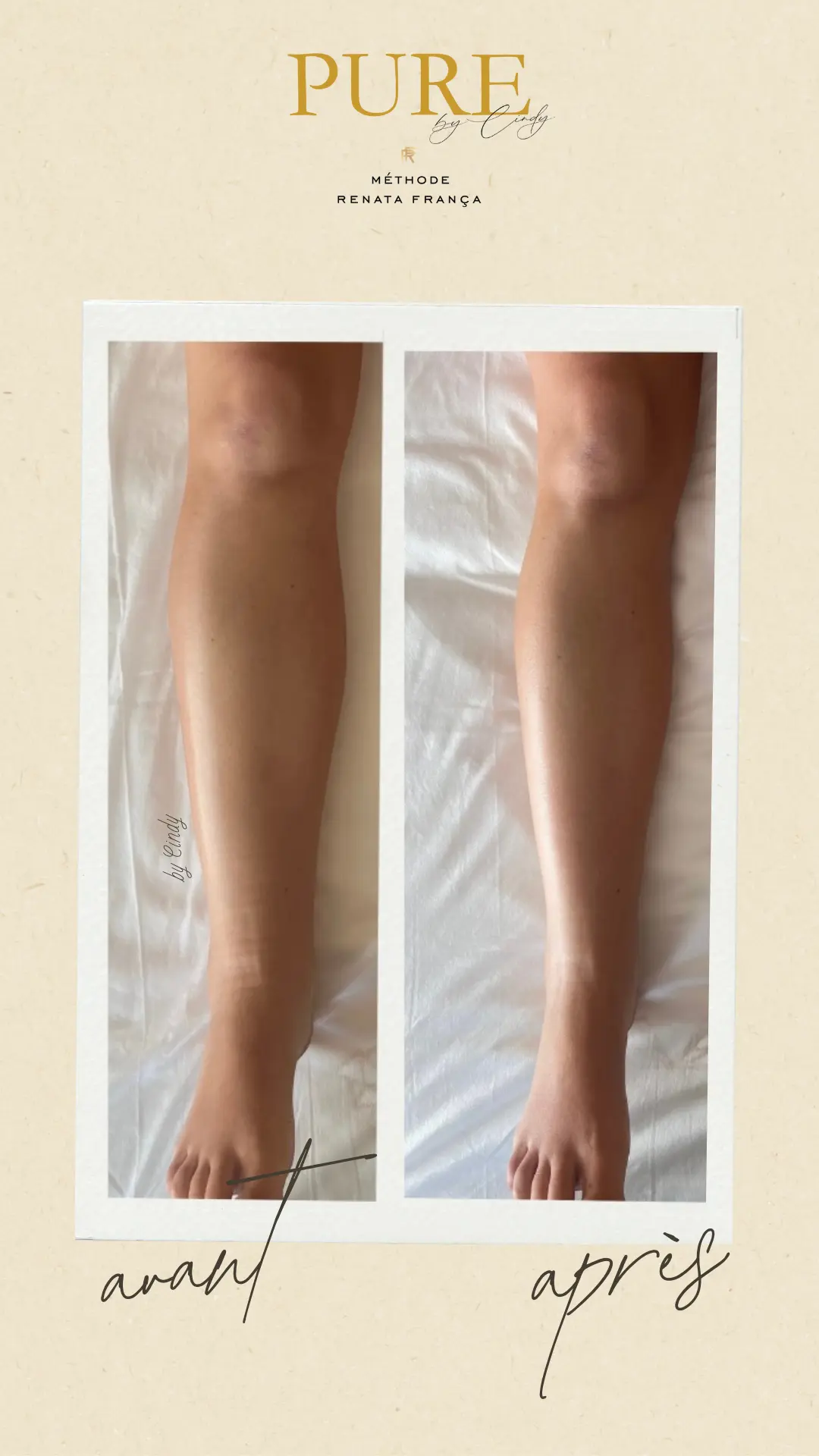 Drainage Lymphatique lymphoedème annemasse